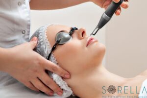 Điều trị nám bằng laser