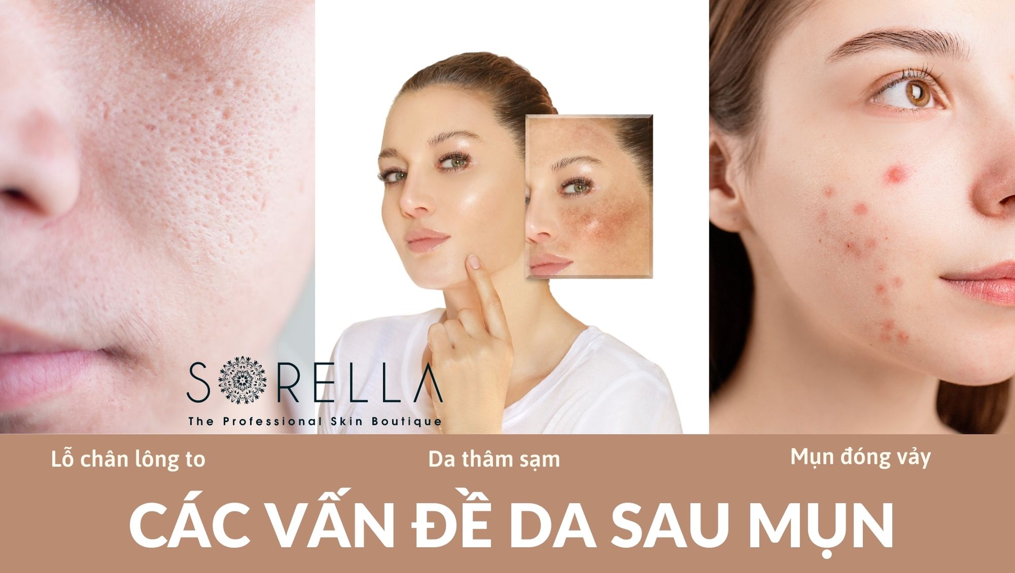 Chăm sóc da sau mụn