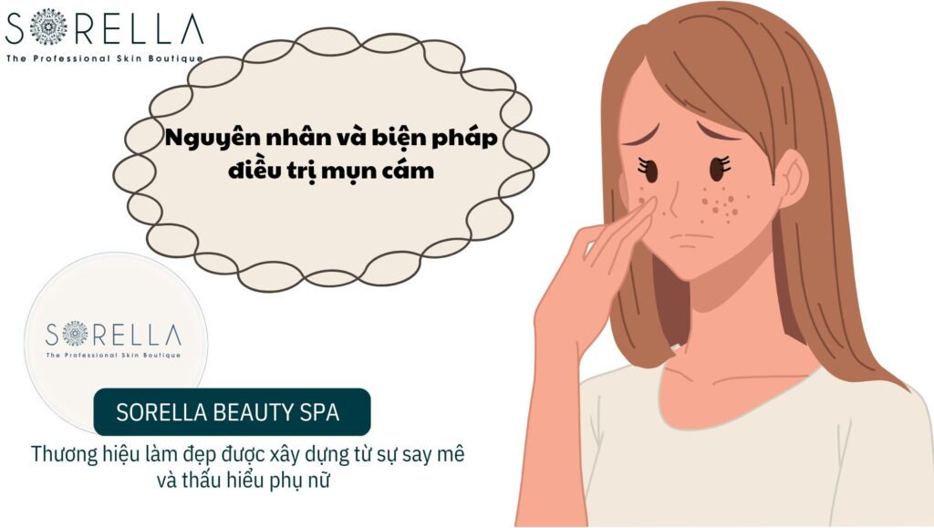 mụn cám