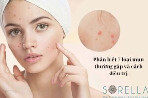 phân biệt 7 loại mụn thường gặp