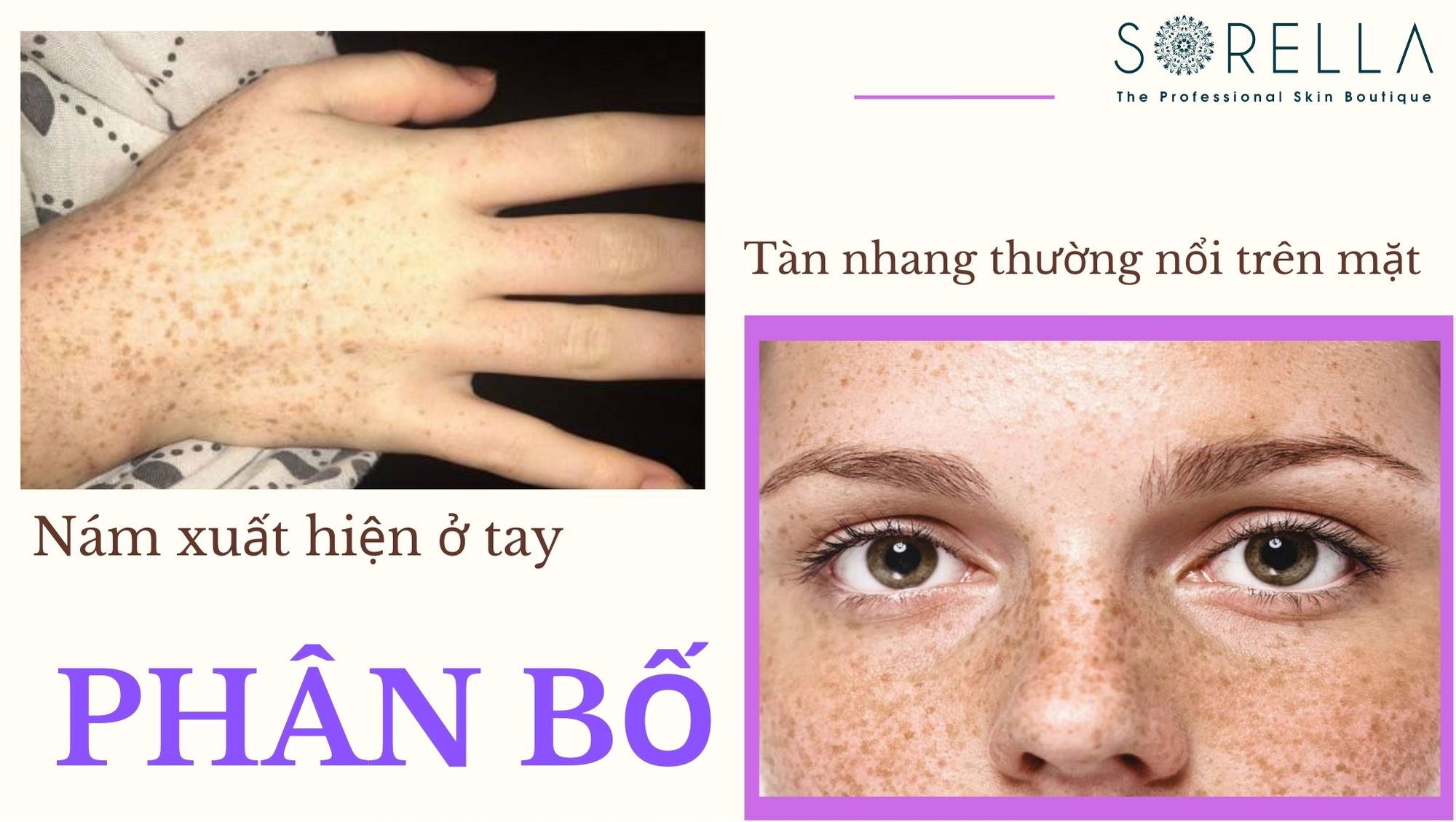Nguyên nhân gây ra nám và tàn nhang