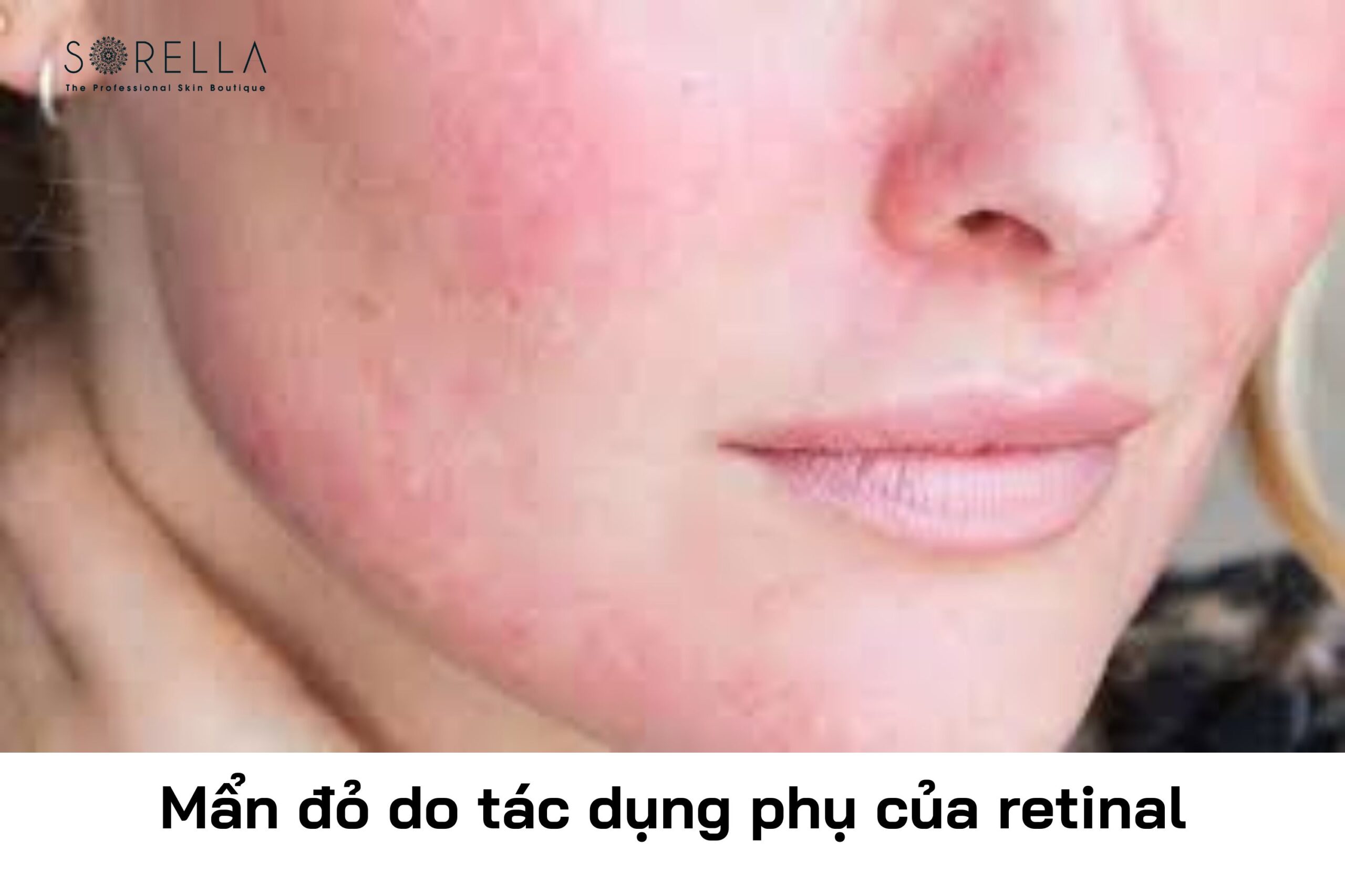 Tác dụng phụ của Retina