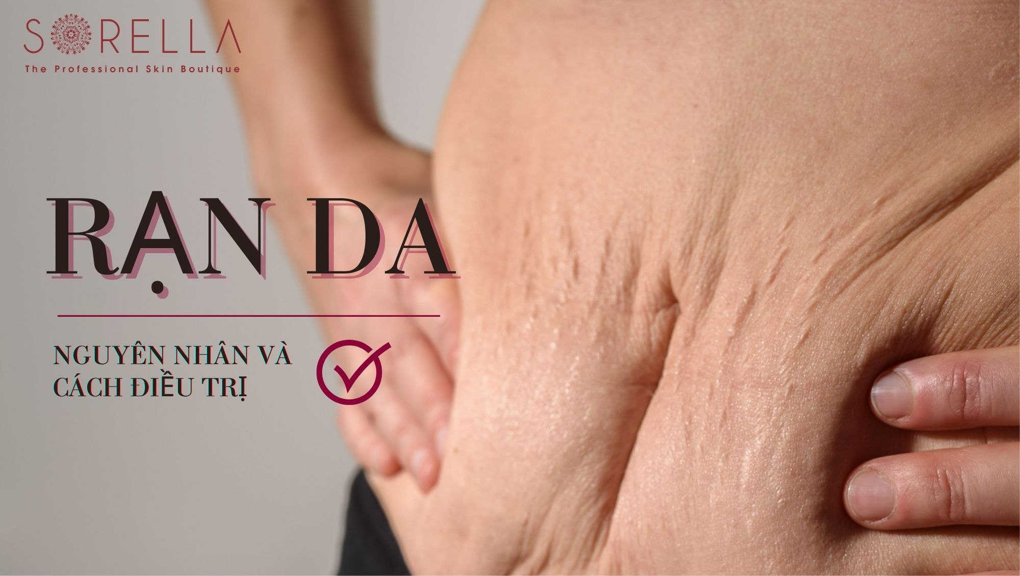 Những cách trị rạn da hiệu quả