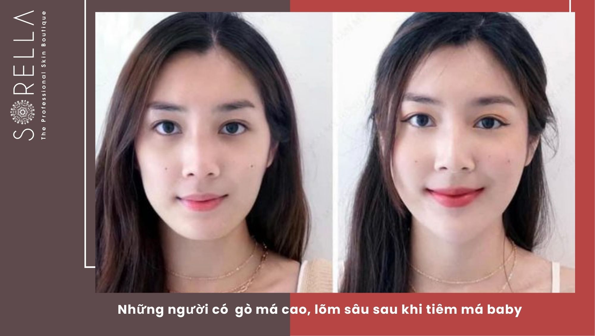 Tiêm má baby là gì?