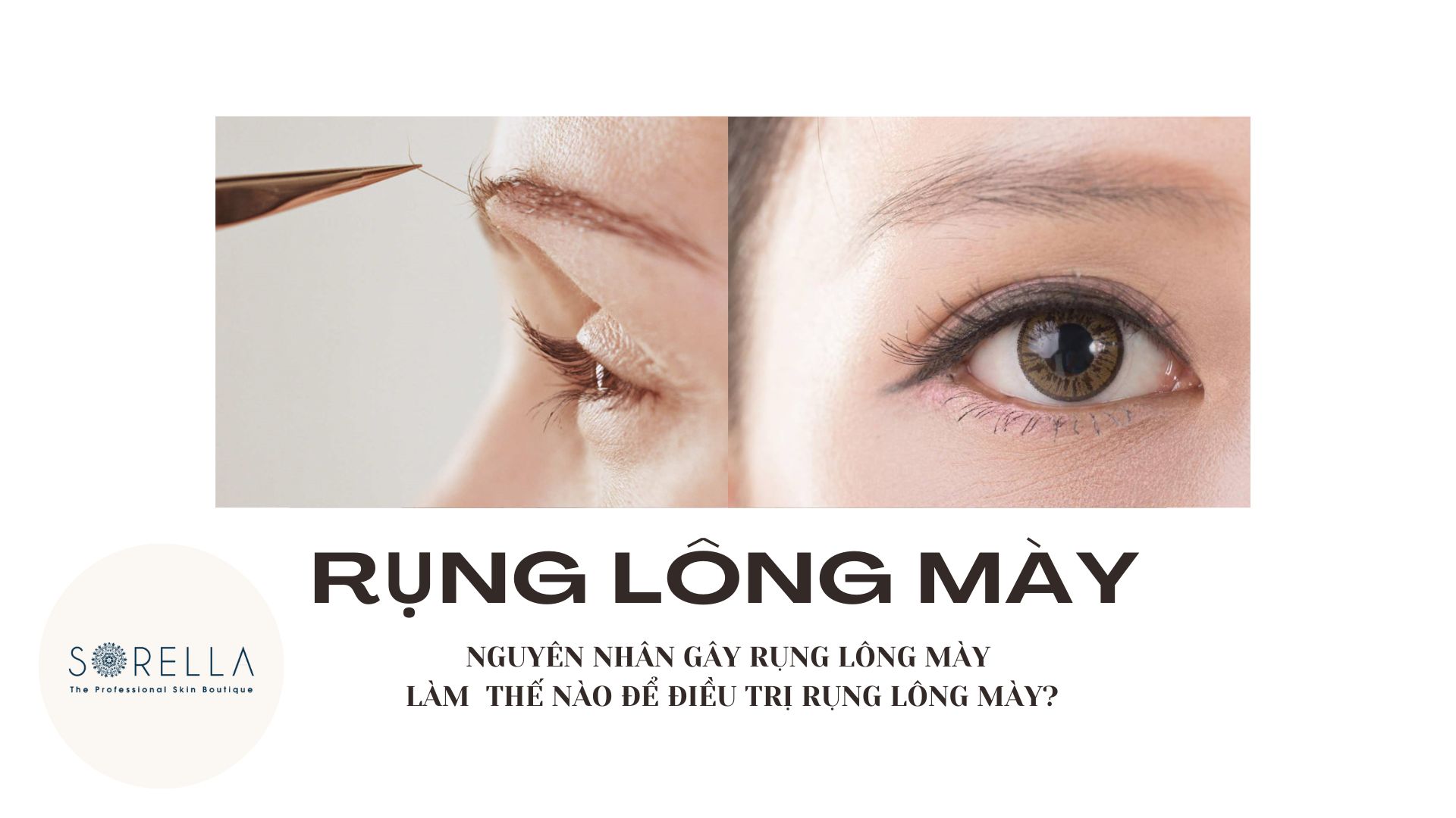 Tại sao lại bị rụng lông mày?
