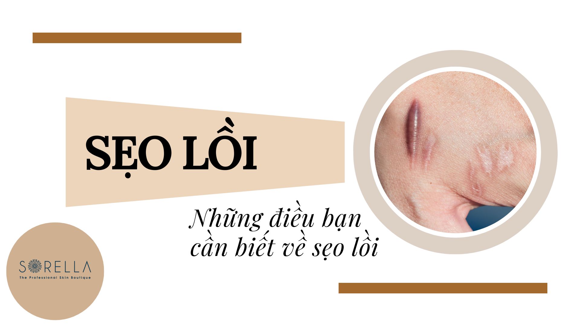 Nguyên nhân và cách điều trị sẹo lồi