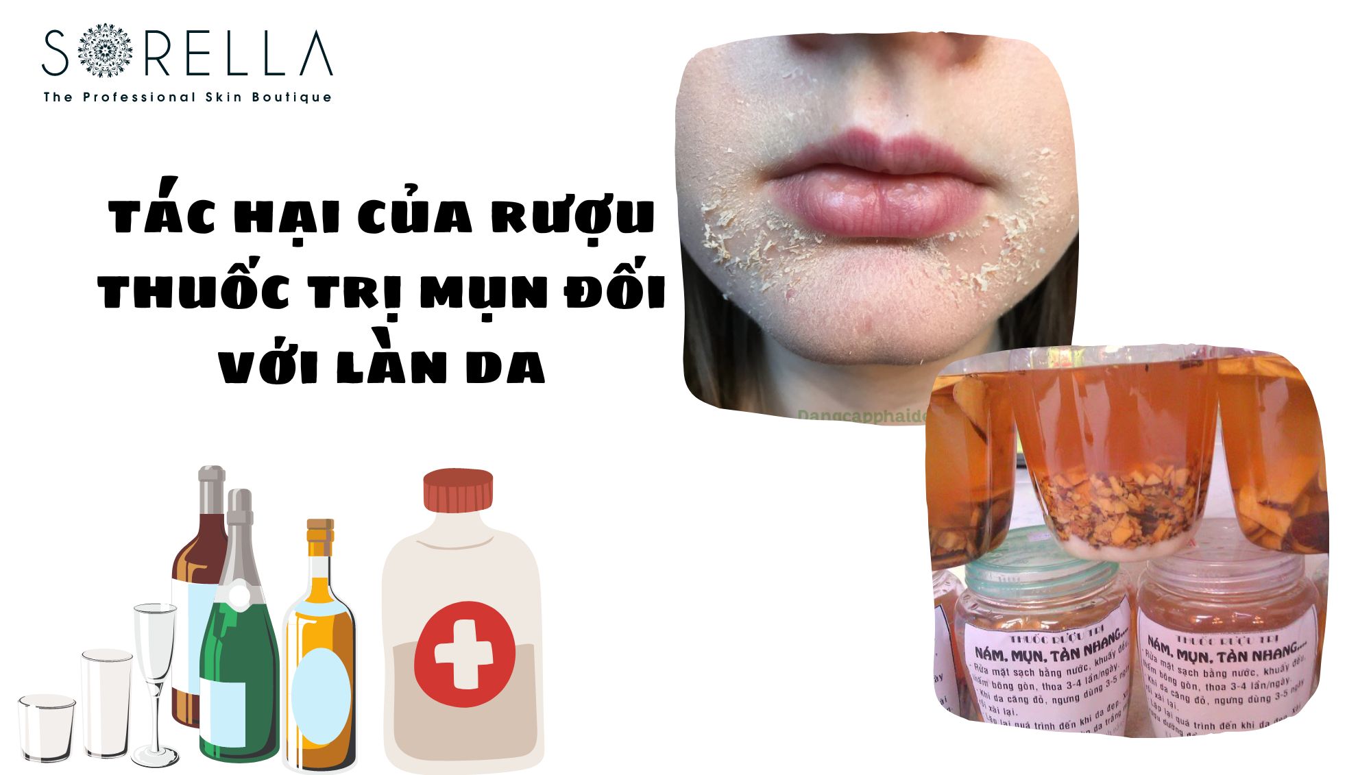 Rượu thuốc trị mụn là gì?