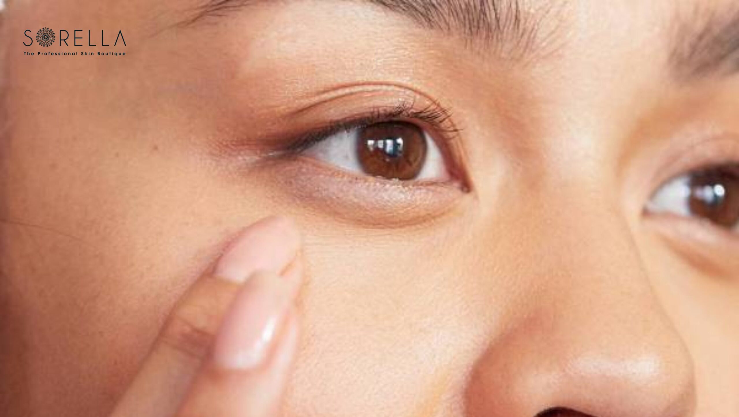 Nguyên nhân và cách chữa bọng mắt