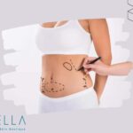 https://sorellafaceliftstudio.com/hut-mo-bung-va-6-dieu-can-luu-y.html hút mỡ bụng