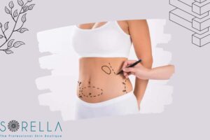 https://sorellafaceliftstudio.com/hut-mo-bung-va-6-dieu-can-luu-y.html hút mỡ bụng