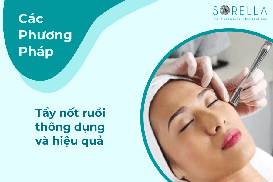 3 Các phương pháp tẩy nốt ruồi thông dụng và hiệu quả.