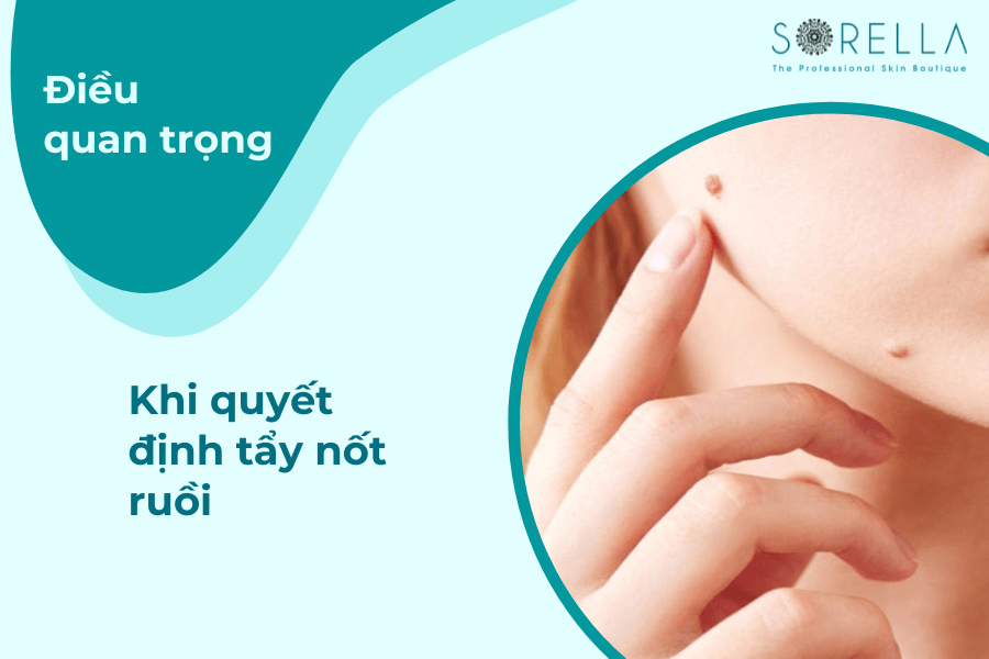 Điều quan trọng khi quyết định tẩy nốt ruồi.