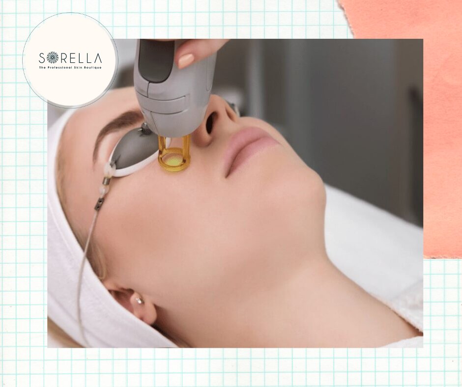 Laser skin resurfacing