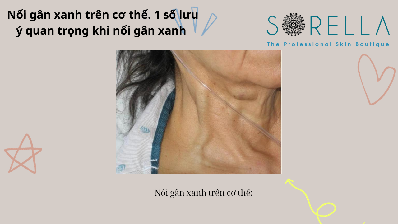 Nổi gân xanh trên cơ thể 