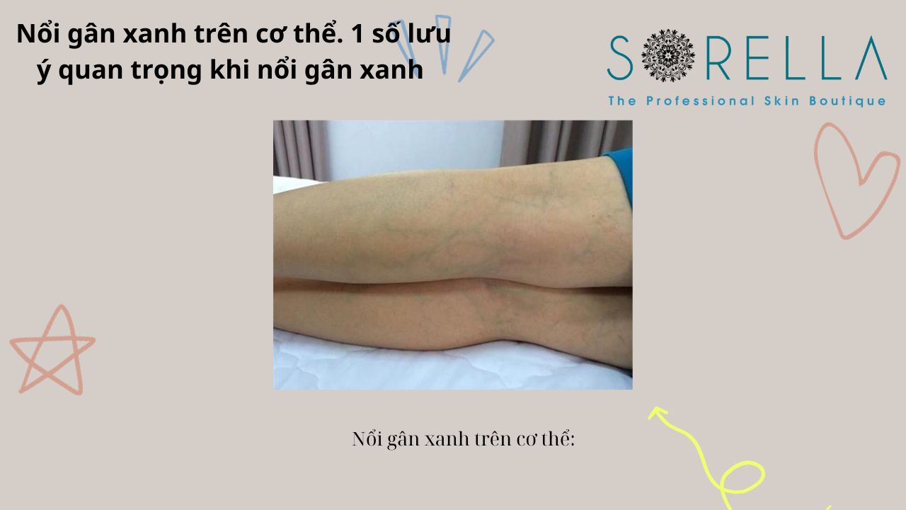 Nổi gân xanh trên cơ thể 