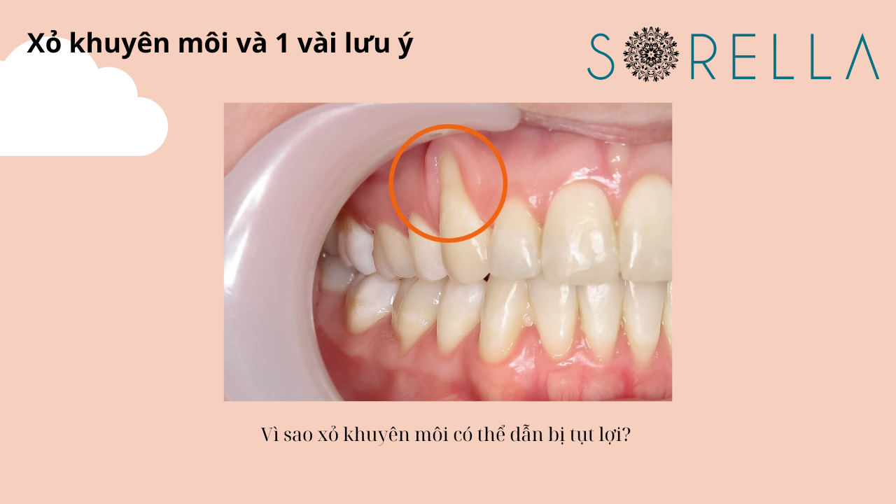 Xỏ khuyên môi và 1 vài lưu ý