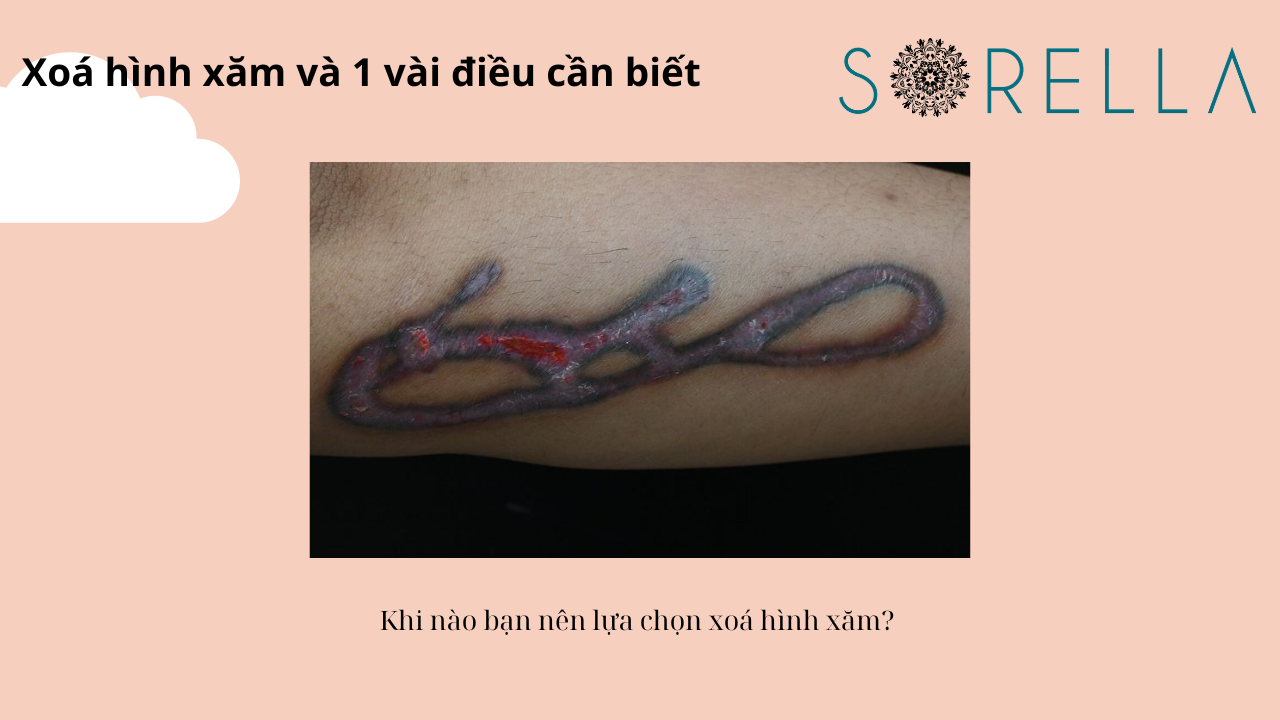 Xóa hình xăm và 1 vài điều cần biết