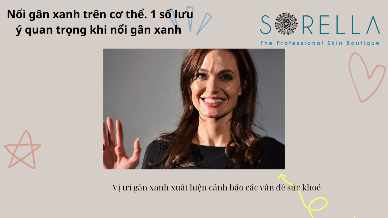 Nổi gân xanh trên cơ thể 