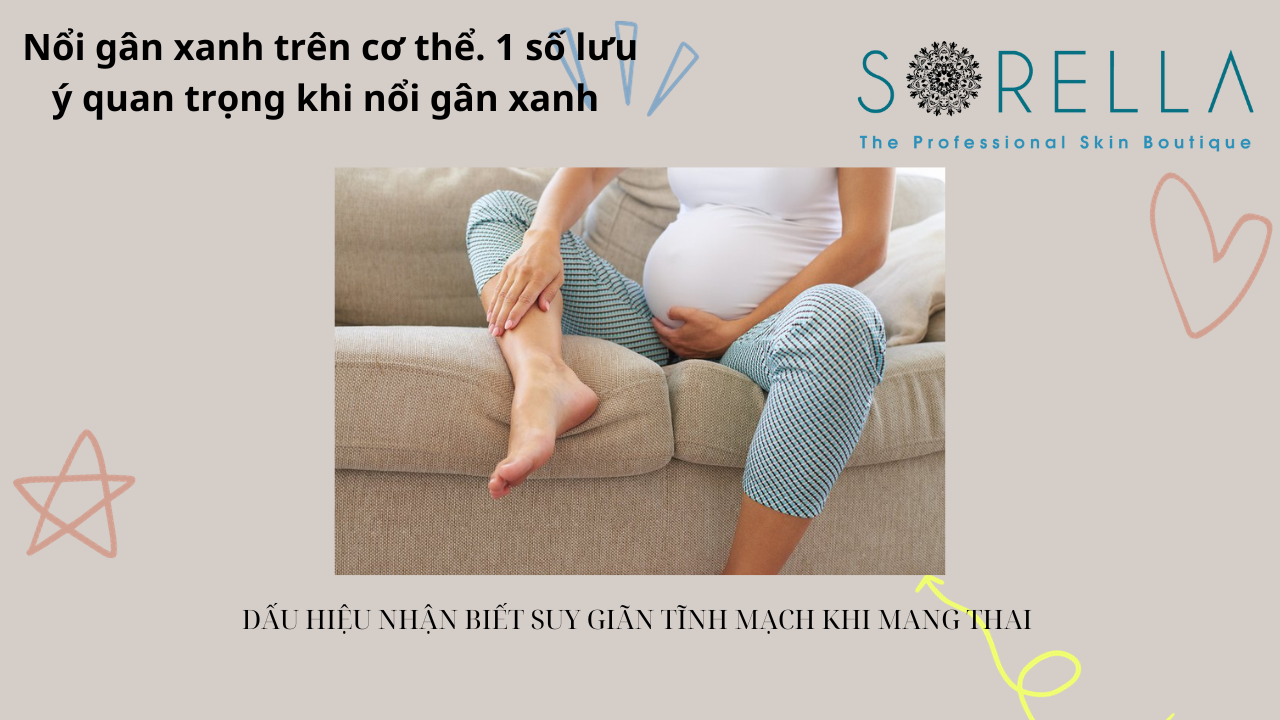Nổi gân xanh trên cơ thể 