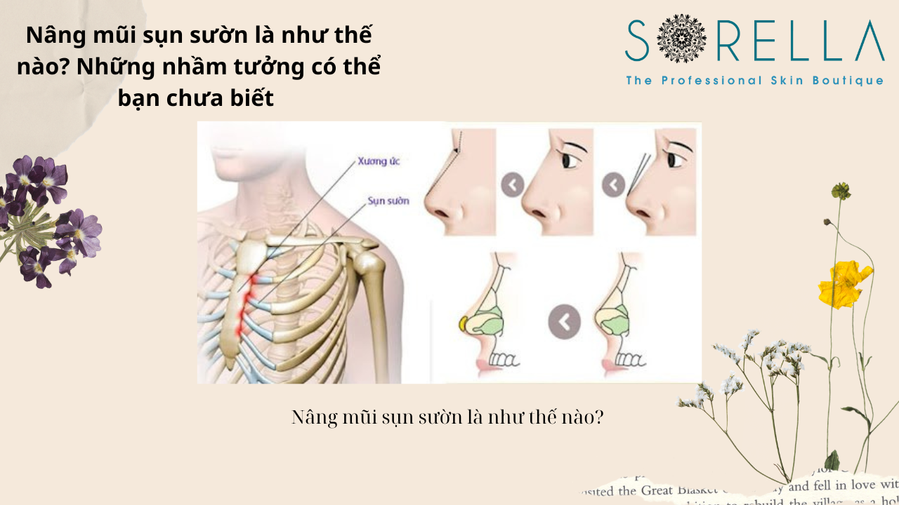 Nâng mũi sụn sườn là như thế nào?