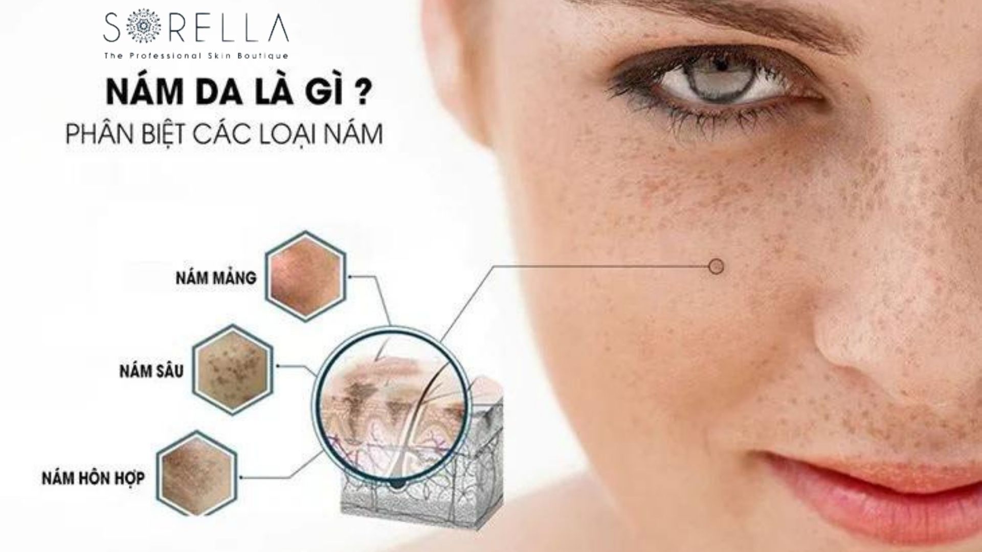 Phân biệt nám da và 5 cách điều trị