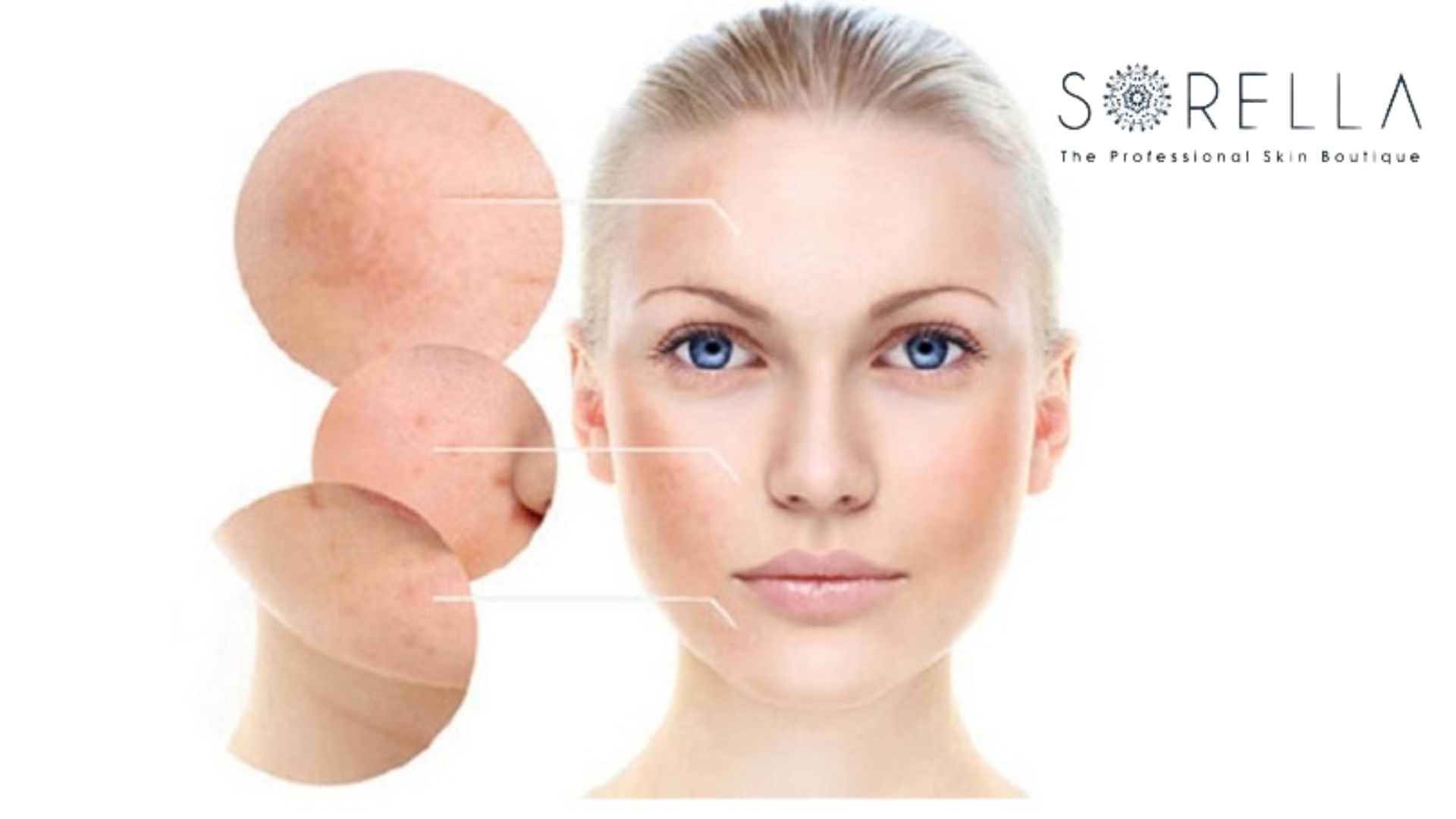 Phân biệt nám da và 5 cách điều trị