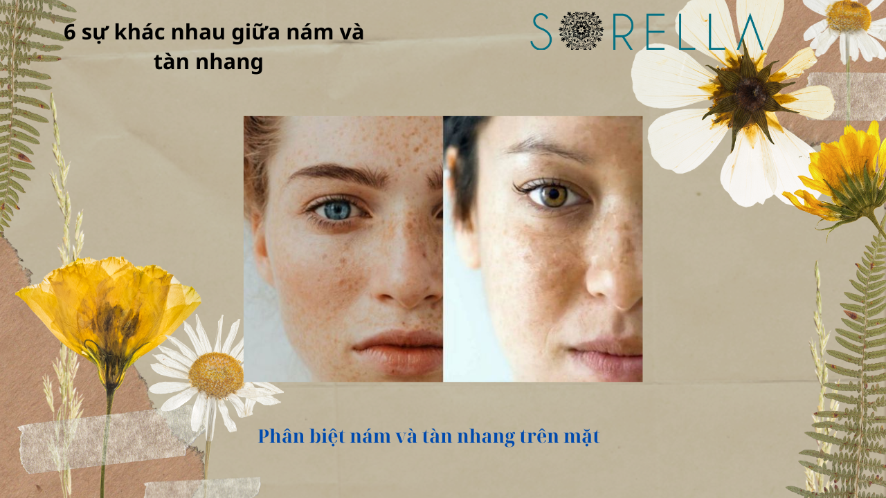 Sự khác nhau giữa nám và tàn nhang