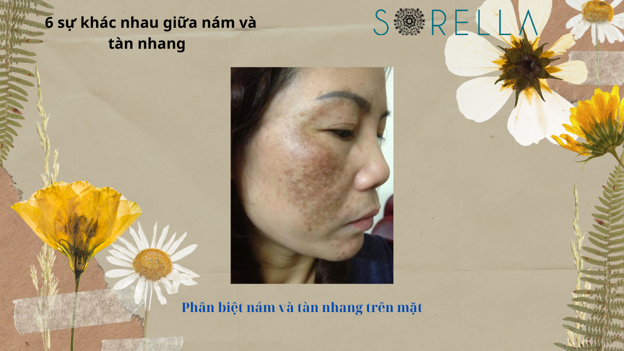 Sự khác nhau giữa nám và tàn nhang