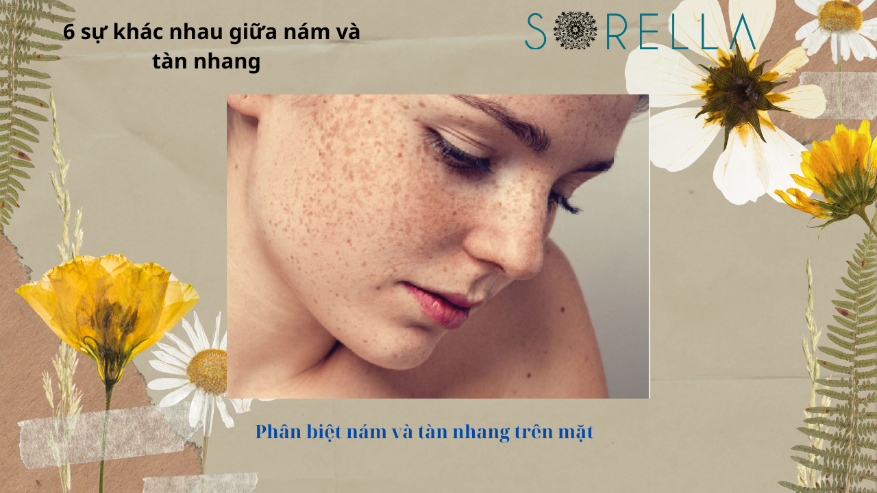 Sự khác nhau giữa nám và tàn nhang