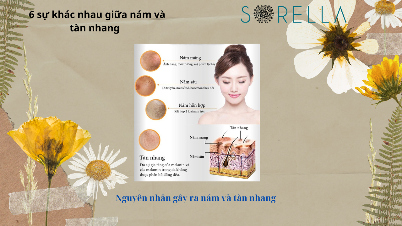 Sự khác nhau giữa nám và tàn nhang