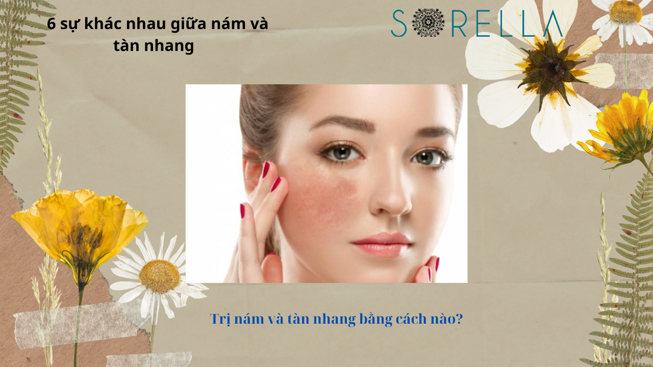 Sự khác nhau giữa nám và tàn nhang