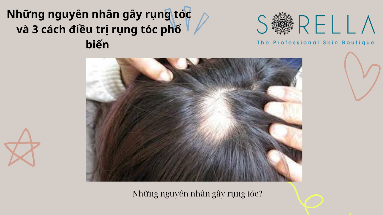 Rụng tóc là như thế nào?