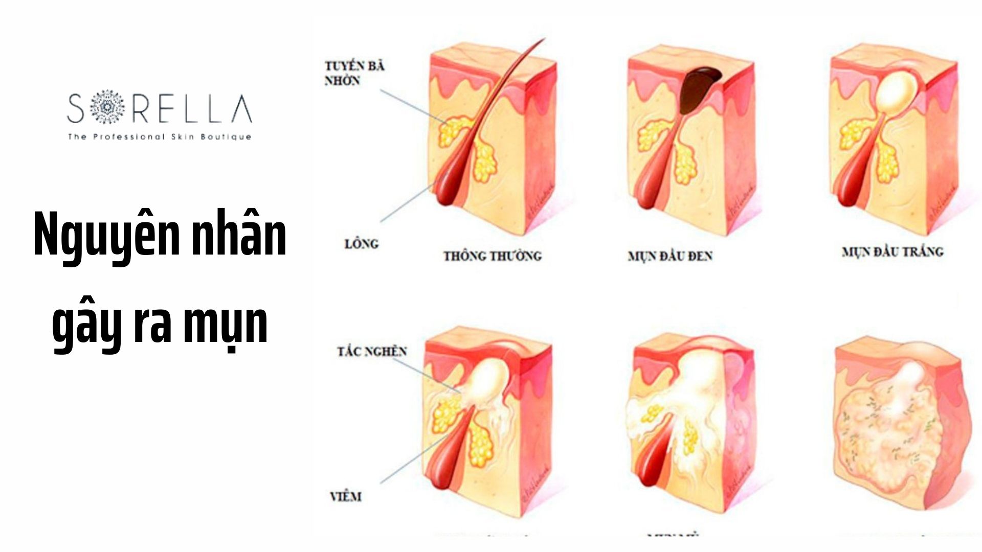 8 nguyên nhân gây ra mụn lưng