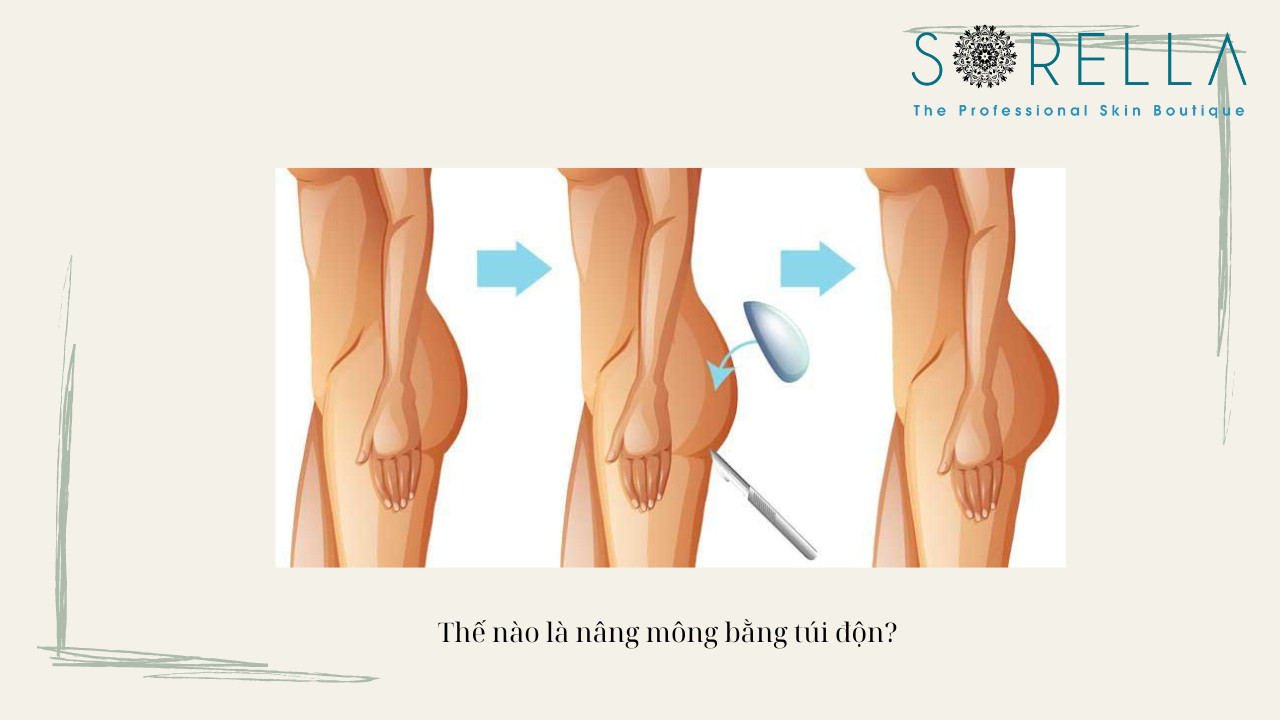 Thế nào là nâng mông bằng túi độn? 