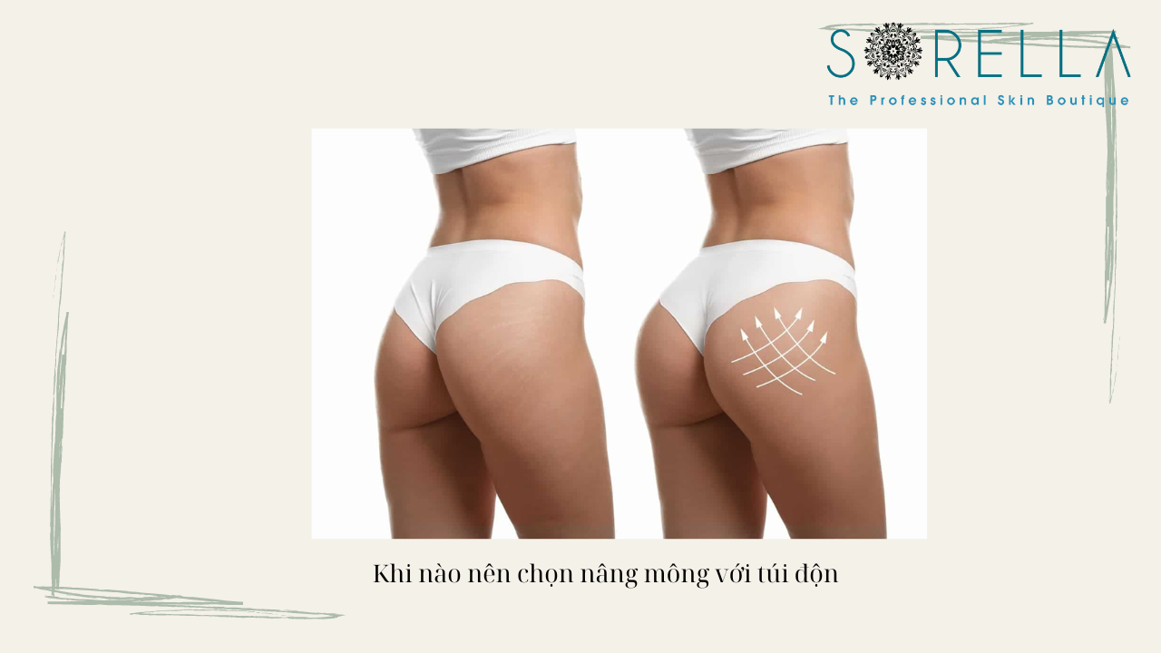 Thế nào là nâng mông bằng túi độn? 