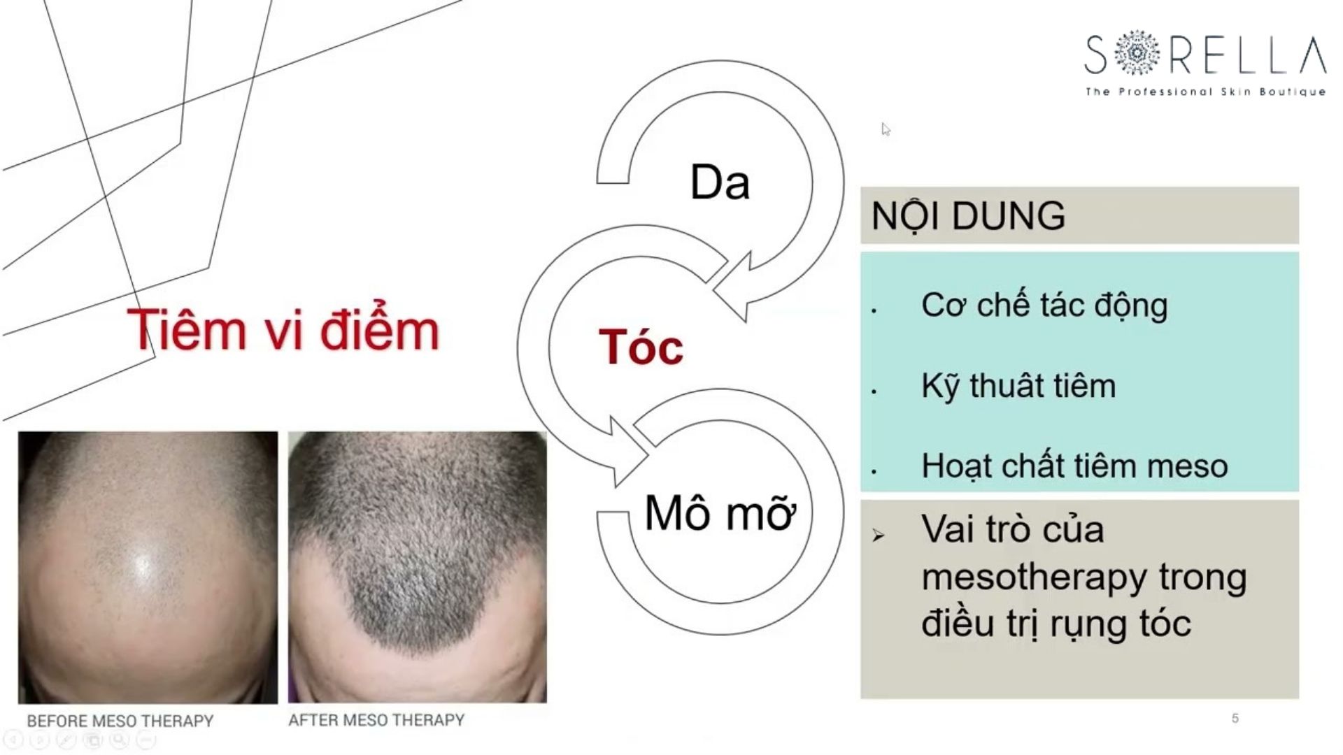 4 lý do nên tiêm meso điều trị rụng tóc