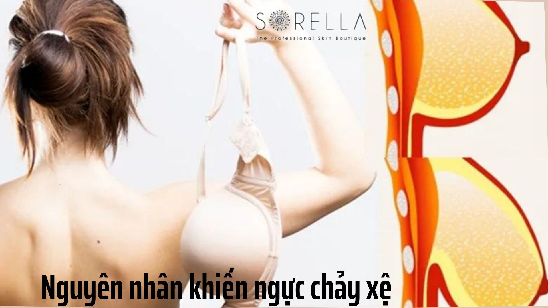 3 phương pháp nâng ngực chảy xệ hiệu quả