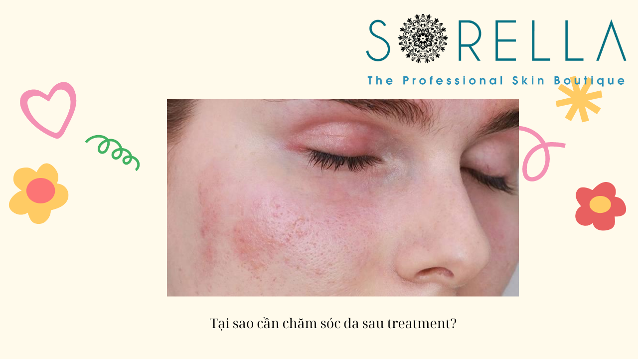 Cách chăm sóc da sau treatment
