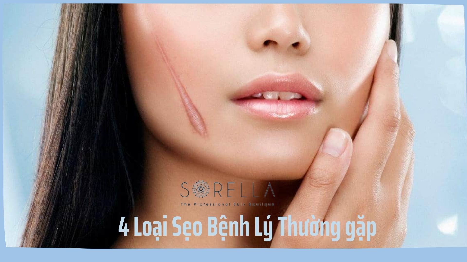4 loại sẹo bệnh lý thường gặp