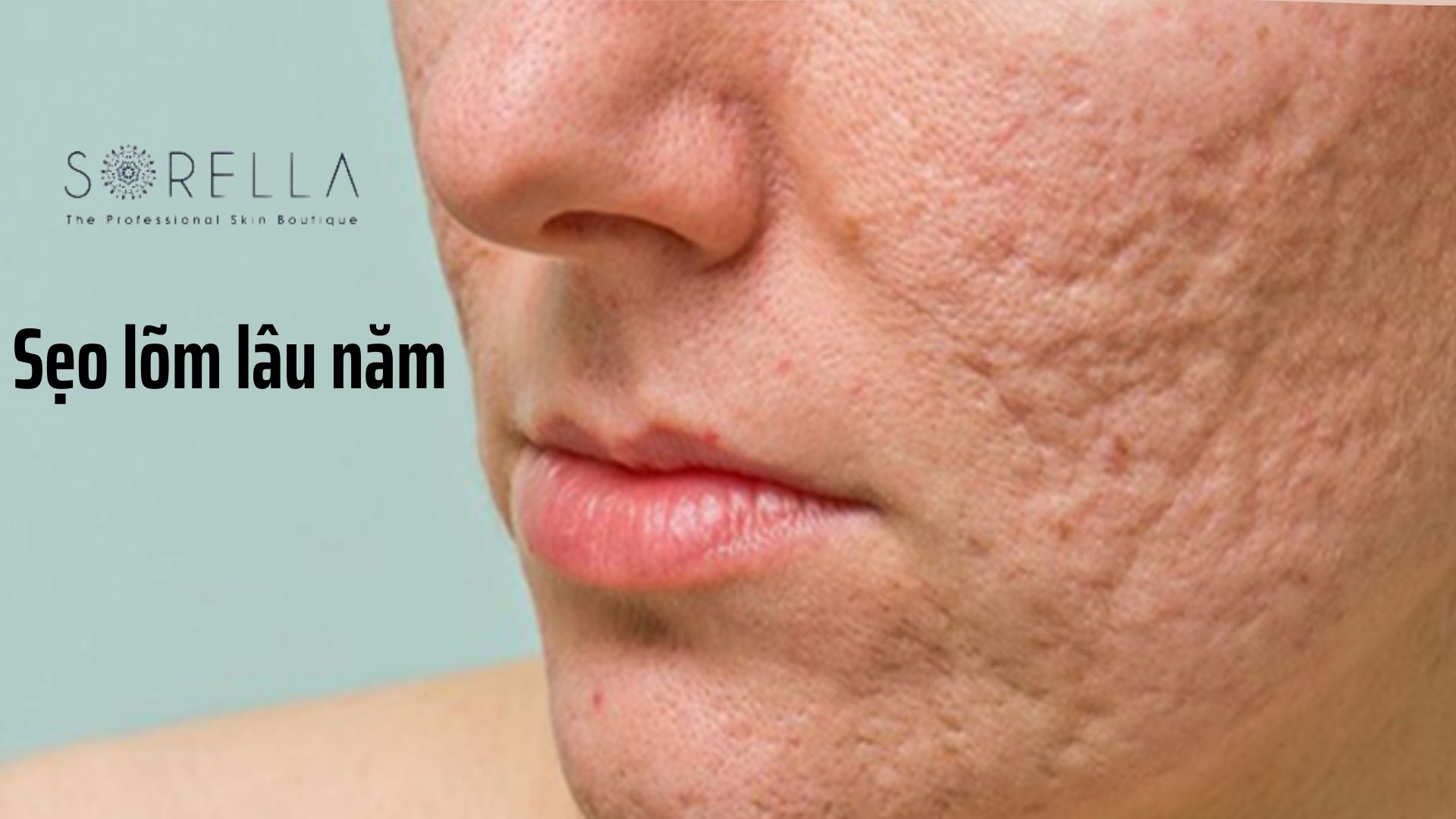 4 loại sẹo bệnh lý thường gặp