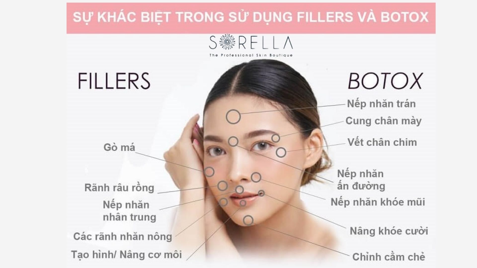 Tiêm filler và botox, 2 phương pháp nâng cơ không phẫu thuật