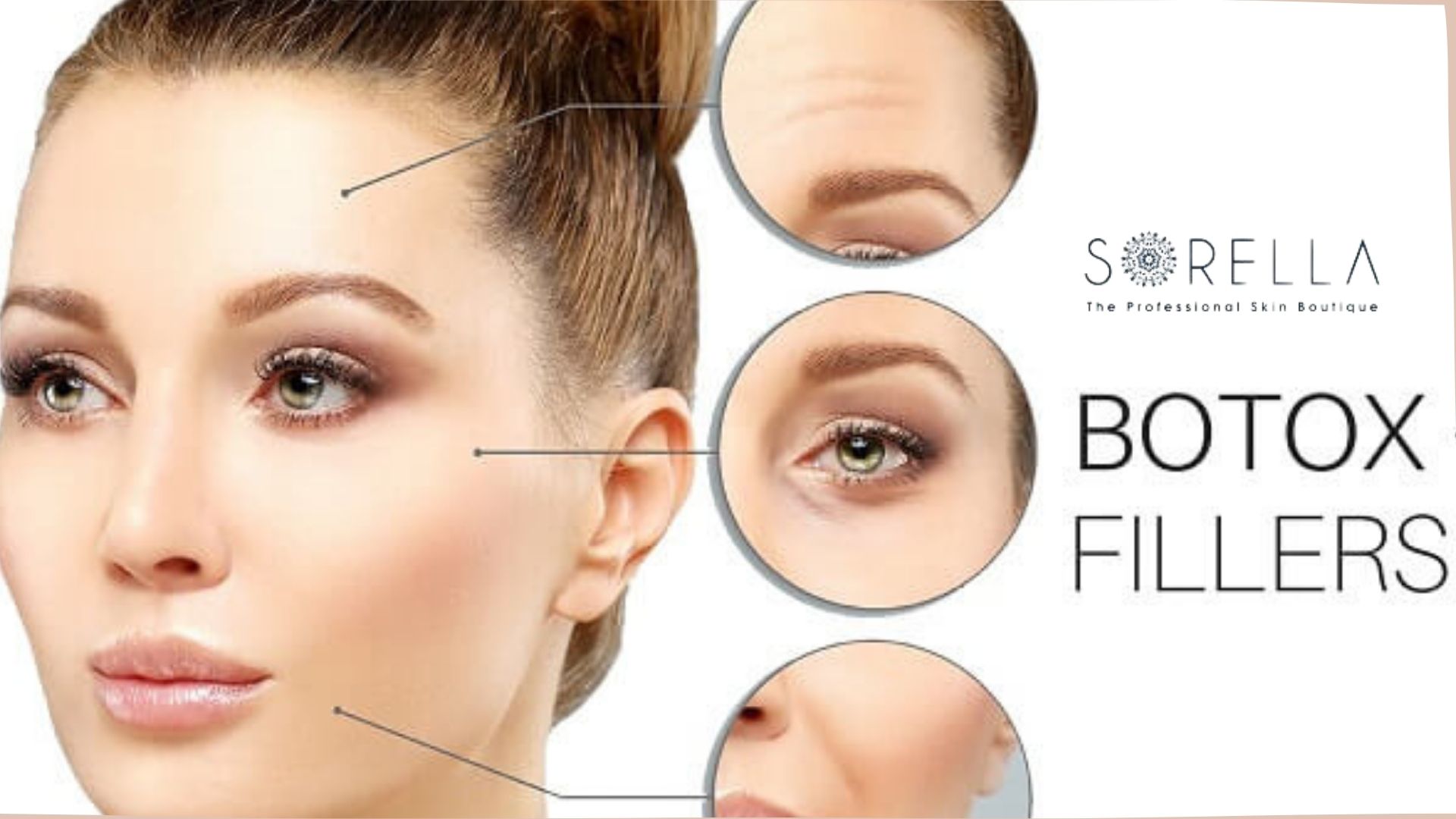 Tiêm filler và botox, 2 phương pháp nâng cơ không phẫu thuật
