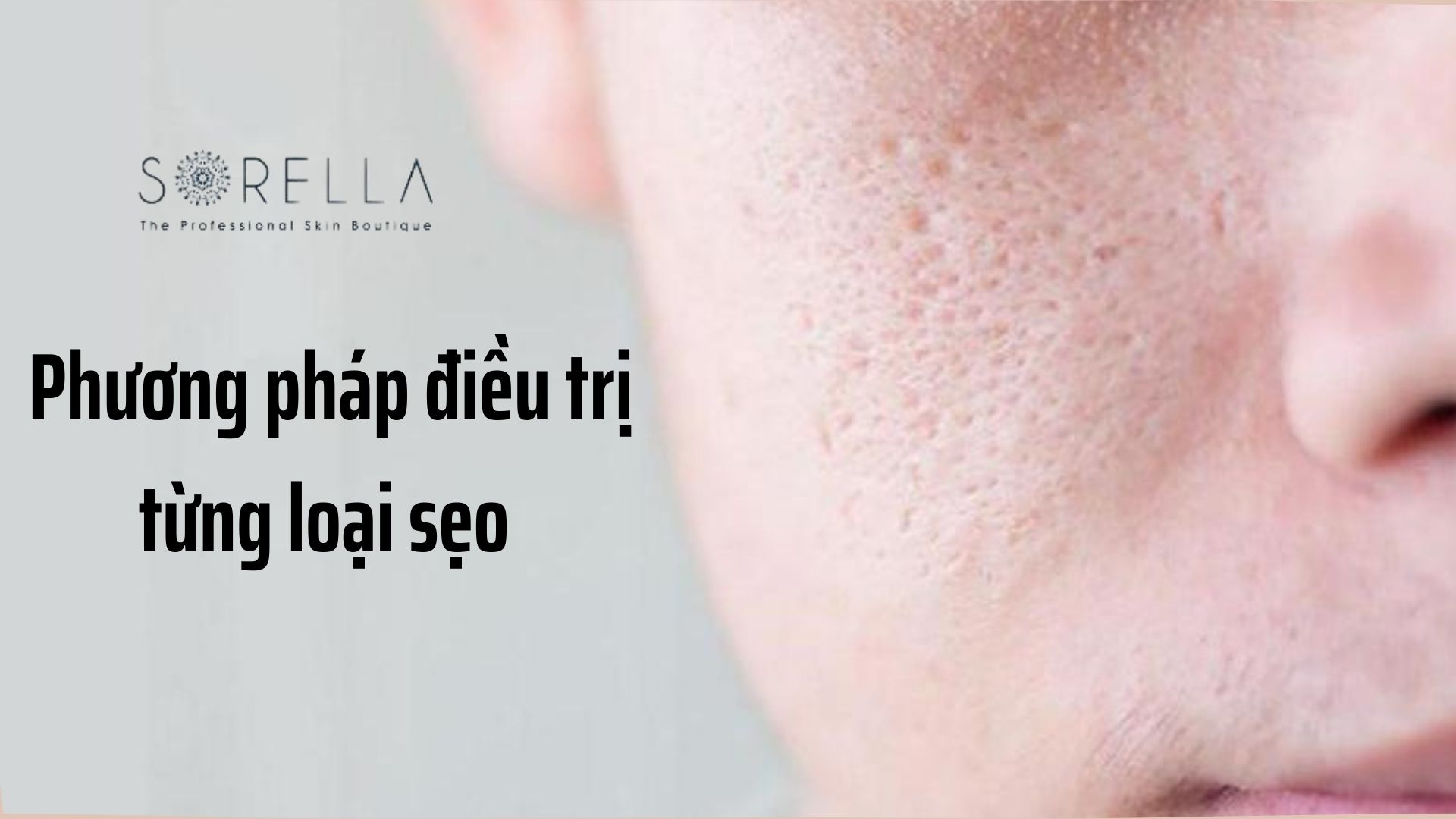 3 cách phân biệt các loại sẹo thường gặp và phương pháp điều trị
