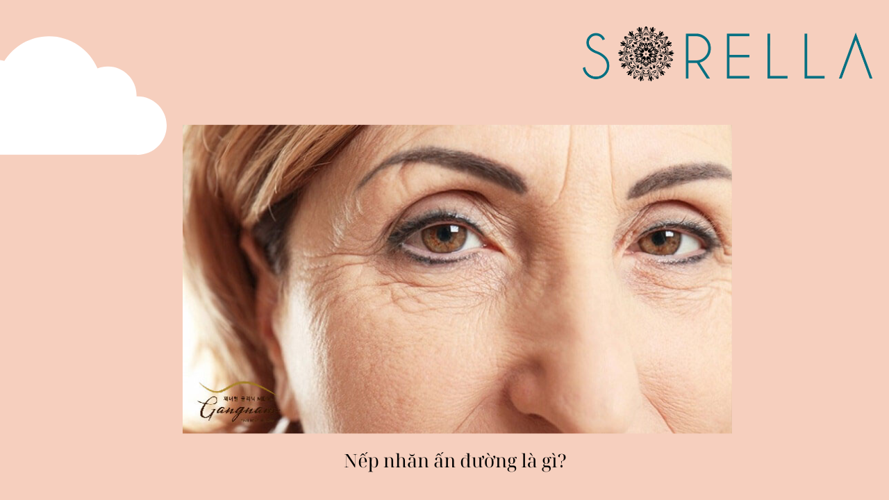 Nếp nhăn ấn đường là gì?