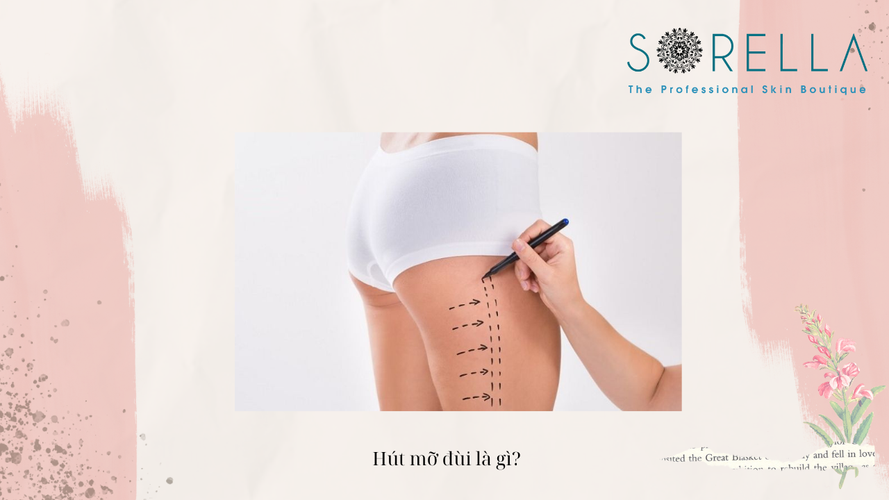 Hút mỡ đùi là gì?