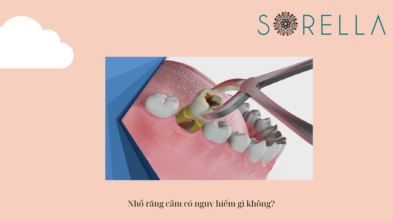 Nhổ răng cấm có nguy hiểm không?