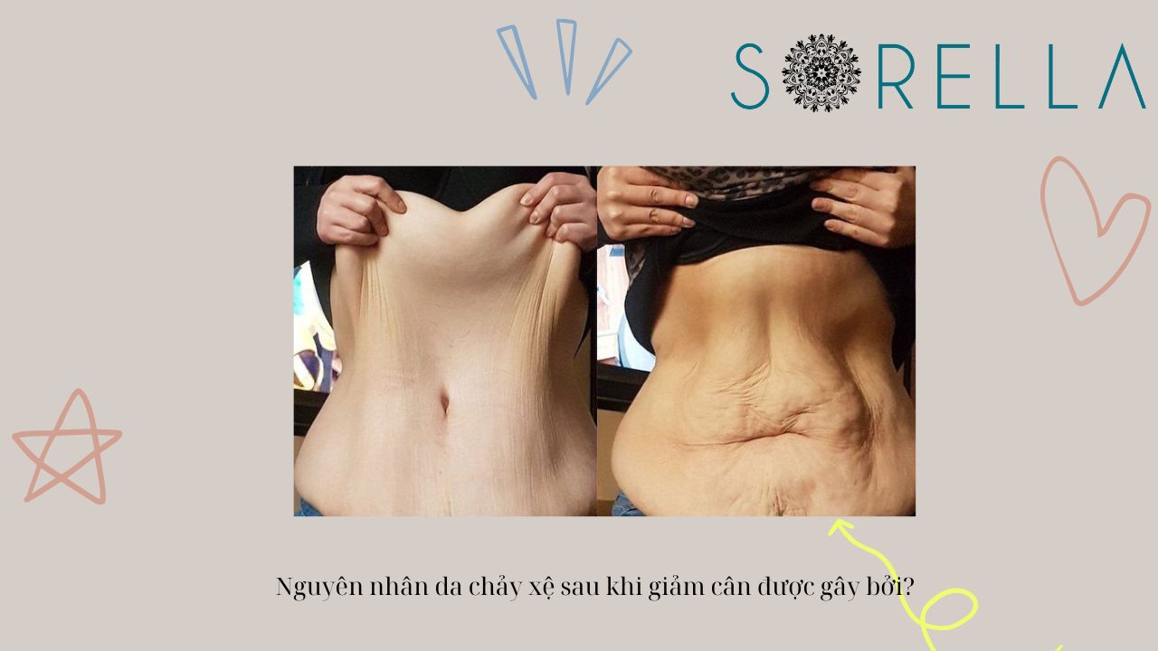 Làm sao để săn chắc da sau khi giảm cân?