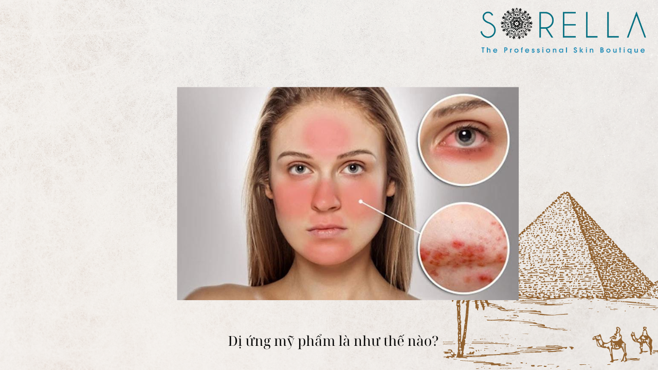 Bị dị ứng mỹ phẩm uống thuốc gì?
